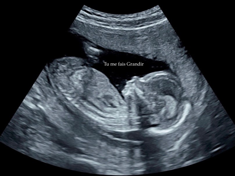 Echographie premier trimestre grossesse